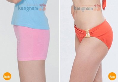Kết quả hình ảnh cho site:nangmongnoisoi.vn nâng mông bằng mỡ tự thân