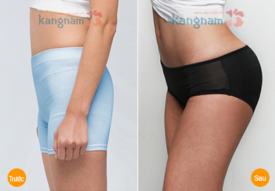 Kết quả hình ảnh cho site:nangmongnoisoi.vn nâng mông bằng mỡ tự thân